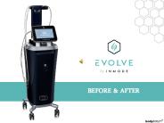 EVOLVE by InMode – Before & After