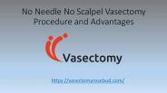 No Needle No Scalpel Vasectomy