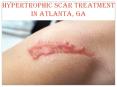 HYPERTROPHIC SCAR TREATMENT IN ATLANTA, GA PowerPoint PPT Presentation