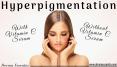 Does Vitamin C Help in Hyperpigmentation PowerPoint PPT Presentation