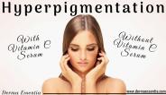 Does Vitamin C Help in Hyperpigmentation