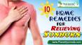 Top 10 Home Remedies for Sunburn Relief PowerPoint PPT Presentation