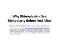 Why Rhinoplasty – See Rhinoplasty Before And After PowerPoint PPT Presentation