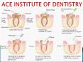 Get Rotary Endodontics Course And Endodontic Certificate Course And also All Endodontic courses in India PowerPoint PPT Presentation