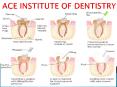 Rotary Endodontics Course, Endodontics course India, Endodontic courses in India, Endodontic Certificate Course PowerPoint PPT Presentation