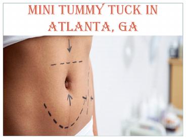 MINI TUMMY TUCK IN ATLANTA, GA