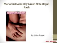 Mononucleosis May Cause Male Organ Rash