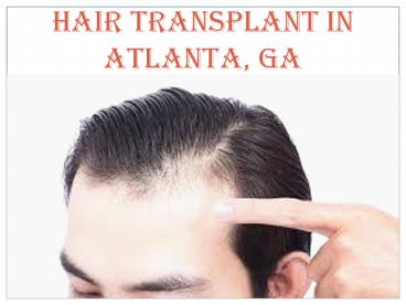 HAIR TRANSPLANT IN ATLANTA, GA