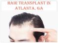 HAIR TRANSPLANT IN ATLANTA, GA PowerPoint PPT Presentation
