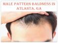 MALE PATTERN BALDNESS IN ATLANTA, GA PowerPoint PPT Presentation
