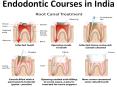 What are the Benefits of Rotary Endodontics Course  and Endodontic Courses in India PowerPoint PPT Presentation