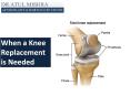 Best Knee Replacement Surgery in Delhi NCR, Total Knee surgeon (1) PowerPoint PPT Presentation