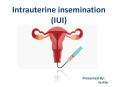 आईयुआई क्या है ? | What is Intrauterine Insemination? PowerPoint PPT Presentation