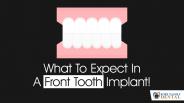What To Expect In A Front Tooth Implant