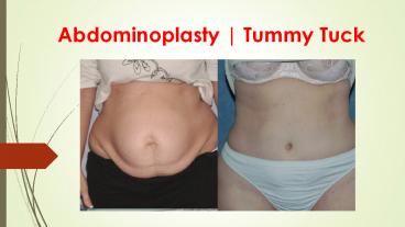 Tummy Tuck | Abdominoplasty
