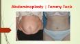 Tummy Tuck | Abdominoplasty PowerPoint PPT Presentation