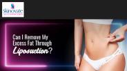 CAN I REMOVE MY EXCESS FAT THROUGH LIPOSUCTION?