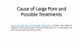 Causes of Large Pores and Possible Treatments PowerPoint PPT Presentation