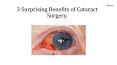 3 Surprising Benefits of Cataract Surgery. PowerPoint PPT Presentation
