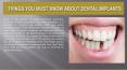 Things you must know about dental implants. PowerPoint PPT Presentation