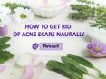 Home Remedies to Get Rid of Acne Scars PowerPoint PPT Presentation