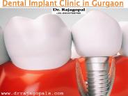 Braces Treatment And Dental Implant Treatment in Gurgaon