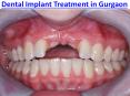 Dental Implant Clinic in Gurgaon | Best Dental Implants in Gurgaon PowerPoint PPT Presentation