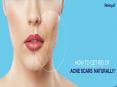 Home Remedies to get rid of acne scars PowerPoint PPT Presentation