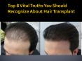 Learn about the 8 Important Facts of that you should Understand about Hair Transplant PowerPoint PPT Presentation