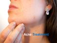 Expert Acne Dermatologist Near Me- Lansing, Mt. Pleasant PowerPoint PPT Presentation