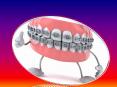 Top 5 Best Braces Treatment in Gurgaon | Best Dental clinic in gurgaon PowerPoint PPT Presentation