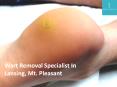 Wart Removal Specialist In Lansing and Mt. Pleasant PowerPoint PPT Presentation