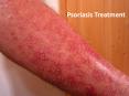 Psoriasis Specialist In Lansing and Mount Pleasant PowerPoint PPT Presentation