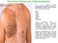 Body Hair Transplant in Bhubaneswar PowerPoint PPT Presentation