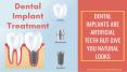 Dental Implant by Dentist Countryside Dr PowerPoint PPT Presentation