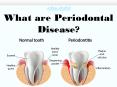 What are Periodontal Disease? PowerPoint PPT Presentation