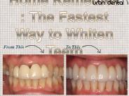 Home Remedies : The Fastest Way to Whiten Teeth