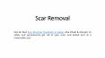 Scar Removal PowerPoint PPT Presentation