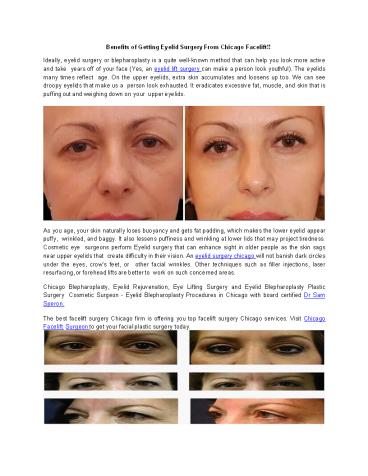 Benefits of Getting Eyelid Surgery From Chicago Facelift