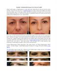 Benefits of Getting Eyelid Surgery From Chicago Facelift PowerPoint PPT Presentation