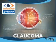 Glaucoma Centre in Indore