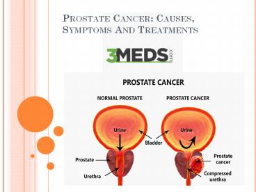 Symptoms Prostate  Cancer: Signs, State and Treatment in India