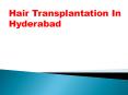 Hair Transplantation In Hyderabad PowerPoint PPT Presentation