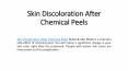 Skin Discoloration After Chemical Peels PowerPoint PPT Presentation