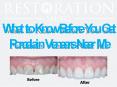 What to Know Before You Get Porcelain Veneers Near Me PowerPoint PPT Presentation