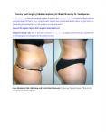 Tummy Tuck Surgery (Abdominoplasty)  in Niles, Illinois by Dr. Sam Speron PowerPoint PPT Presentation