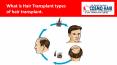 Hair Transplant in Jaipur PowerPoint PPT Presentation