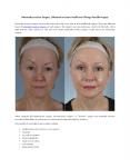 Minimally Invasive Surgery | Minimal Incision Facelift and Chicago Facelift Surgery PowerPoint PPT Presentation