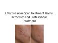 Effective Acne Scar Treatment Home Remedies and Professional Treatment PowerPoint PPT Presentation