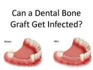 Can a Dental Bone Graft Get Infected?